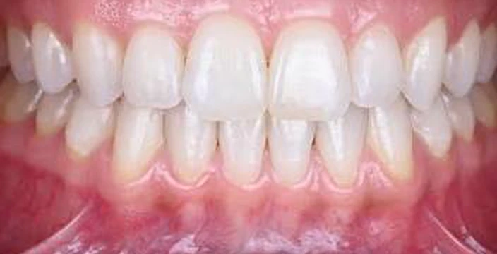 Case 01 — Crowding & midline, After