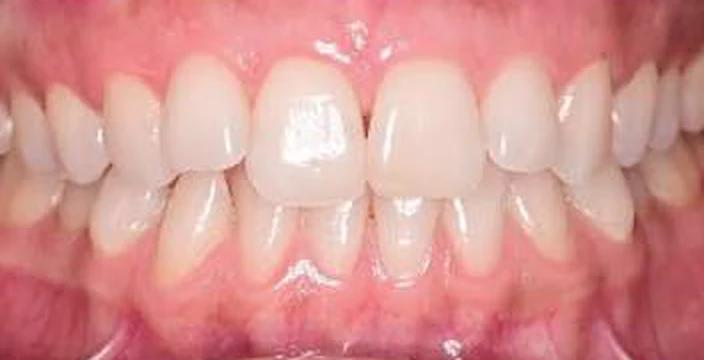 Case 01 — Crowding & midline, Before