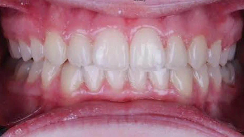 Case 03 — Severe crowding, After