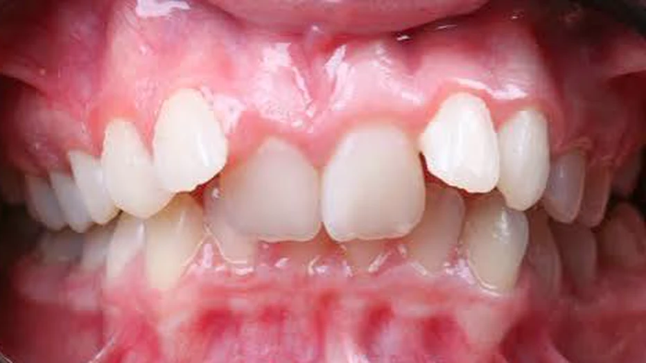 Case 03 — Severe crowding, Before