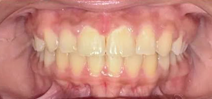 Case 04 — Deep bite & alignment, After