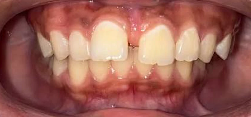 Case 04 — Deep bite & alignment, Before