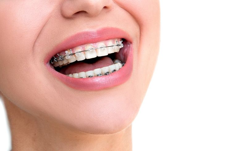 Damon Braces