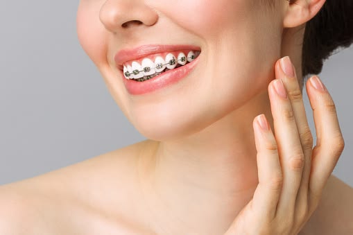 Ceramic Braces