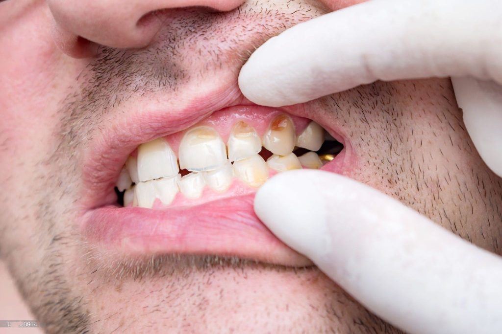 Understanding Different Stages of Tooth Decay